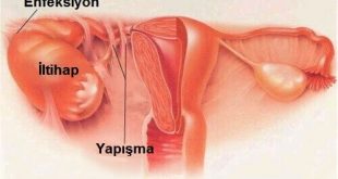 pelvik-inflamatuar-hastaligi-tedavisi