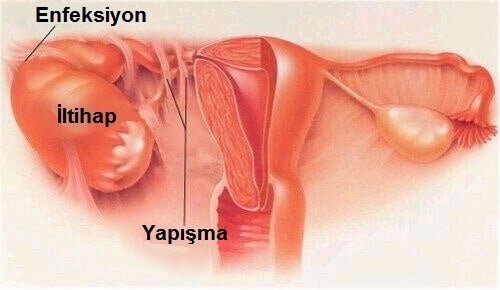 pelvik-inflamatuar-hastaligi-tedavisi