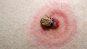 lyme-hastaligi-nedir