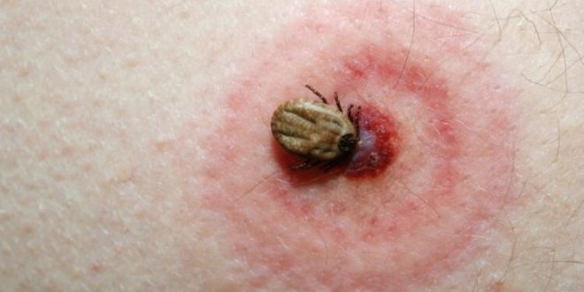lyme-hastaligi-nedir