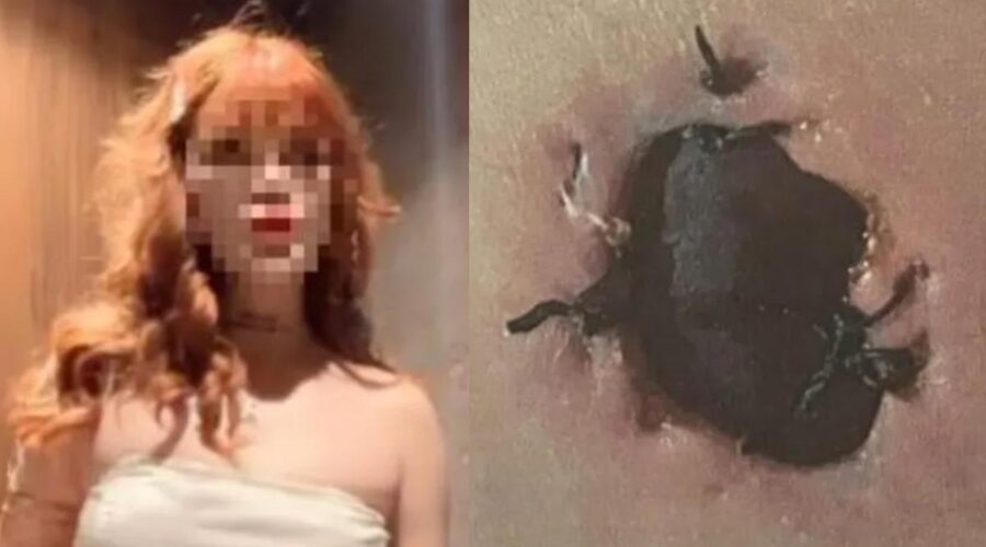 Göğüs Estetiği Sonrası “Deri Kopması” İddiası: Dansçı Doktoru Savcılığa Şikayet Etti